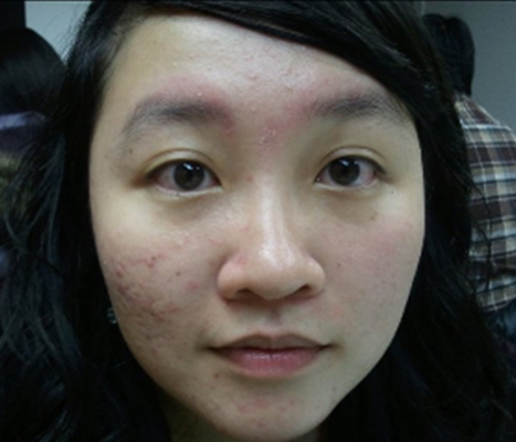 激素臉排毒症狀 (62) 