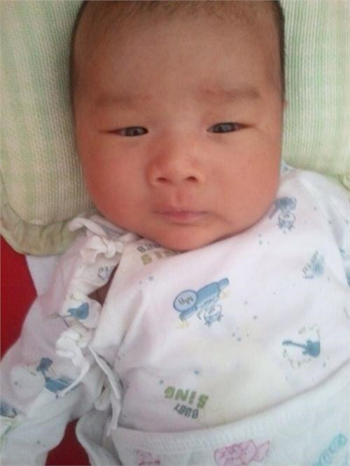 嬰兒先天性斜頸症狀