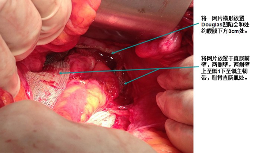子宮脫垂盆底肌修復術