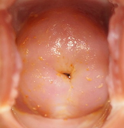 淋病的症狀 (44) 