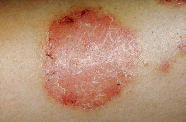 小腿皮膚像魚鱗 (55) 