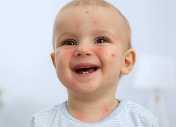 長水痘的症狀 (60) 