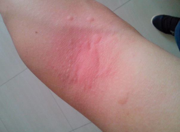 身體蟎蟲過敏症狀