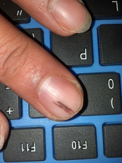 手指甲上有豎紋圖解 (49) 