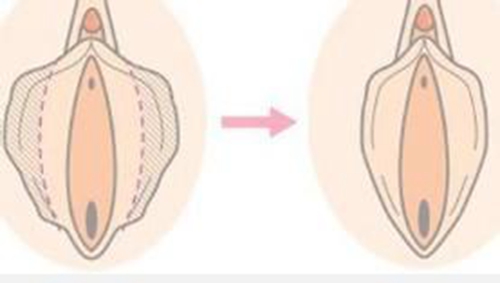 陰唇肥大需要切嗎