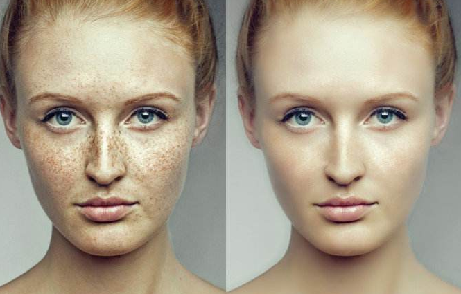 磨皮手術效果圖 (49) 