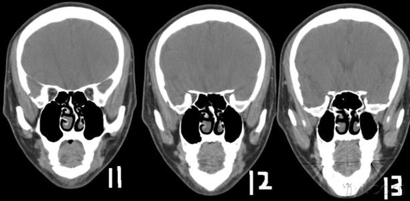 鼻中隔彎曲手術圖解 (49) 