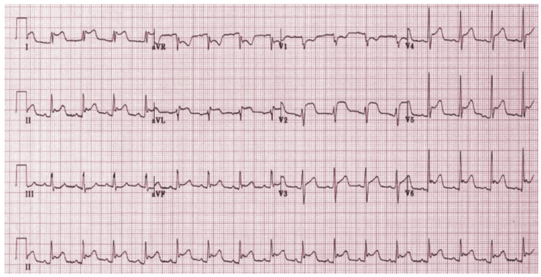 預激綜合徵心電圖 (81) 