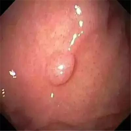 輕微潰瘍性結腸炎表皮異物