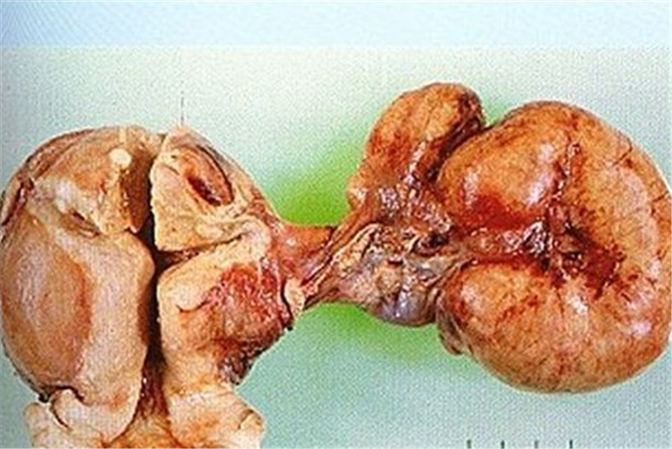 右側卵巢卵巢囊腫