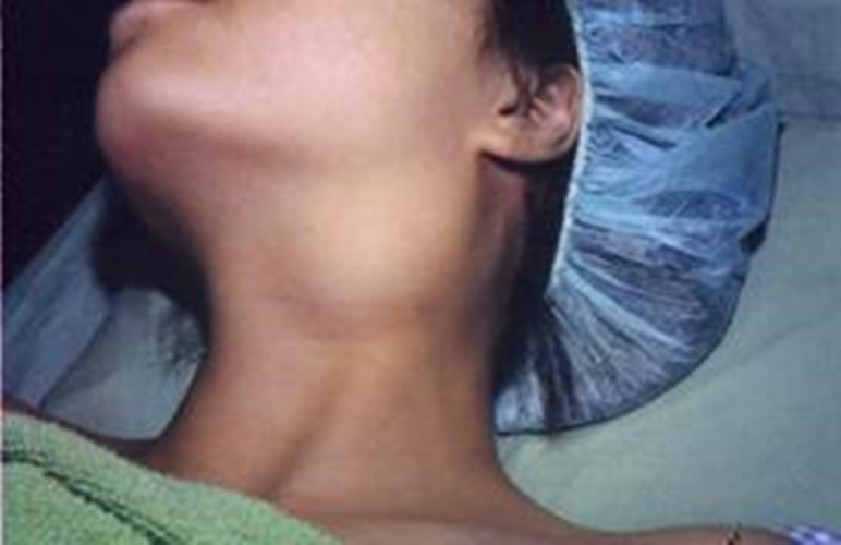 女人的喉腫瘤的表現