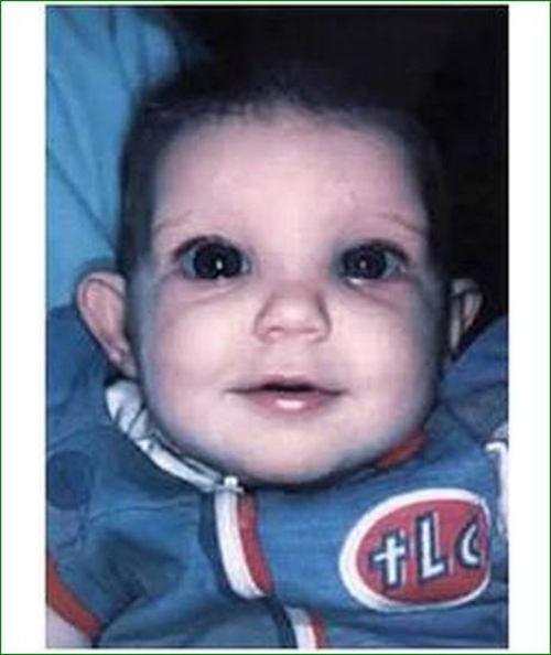 原發性嬰幼兒型青光眼