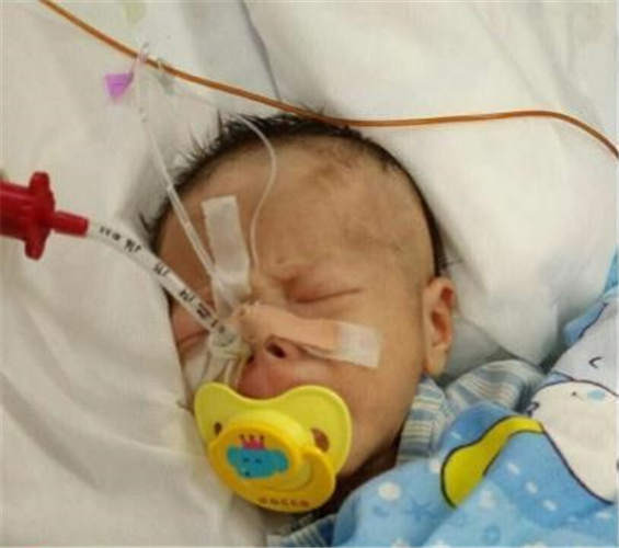 重症先天性喉喘鳴
