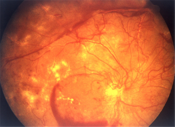 增值引發視網膜脫落