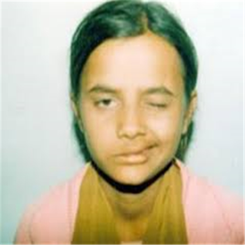 一側面肌痙攣的症狀