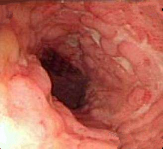 怎麼判斷得了慢性結腸炎的