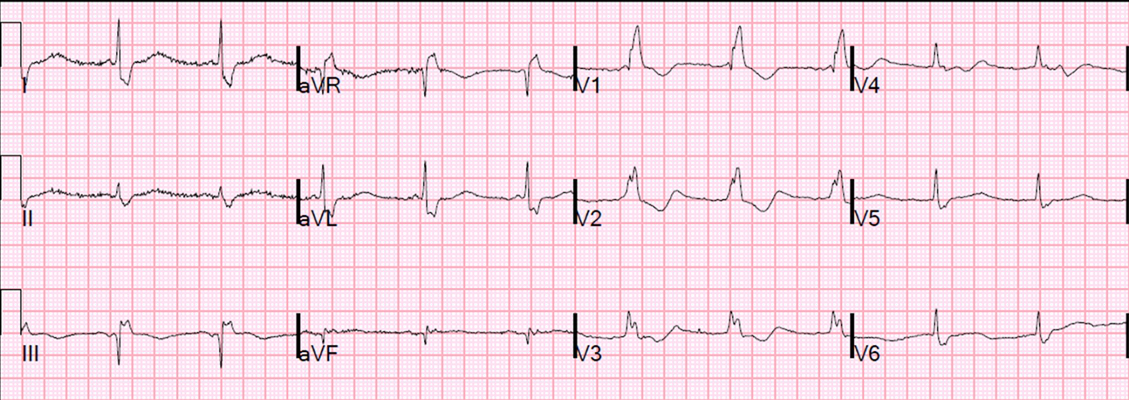 房顫心電圖特點 (66) 