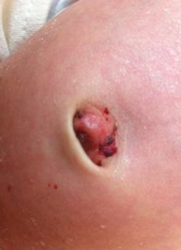 寶寶臍帶脫落後