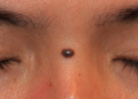 黑痣癌變的徵兆