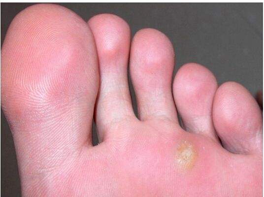 腳底蹠疣早期