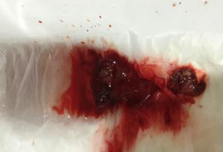 早孕藥流排出孕囊實體