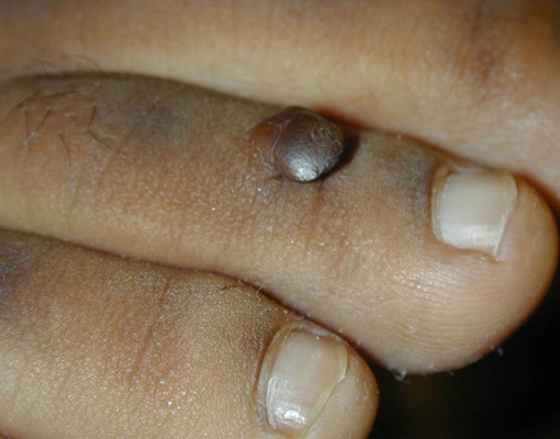 皮膚纖維瘤 (46) 