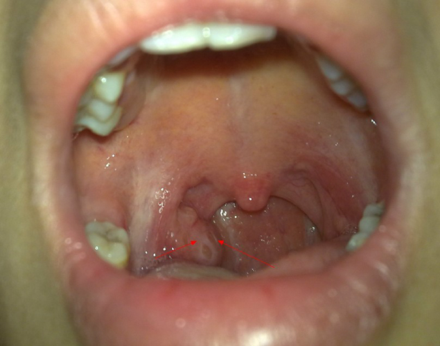 扁桃體癌圖  (8) 