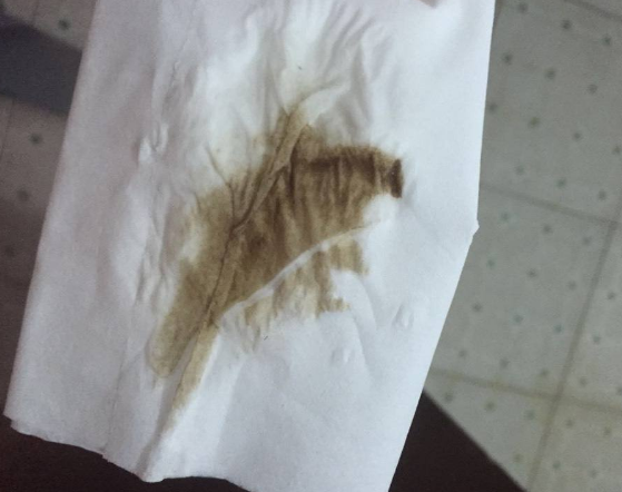 白帶帶有褐色分泌物 (53) 