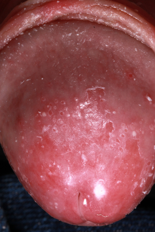 滴蟲性包皮龜頭炎的症狀