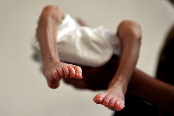 身體消瘦的原因 (67) 