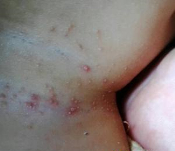 全身白色念珠菌感染 