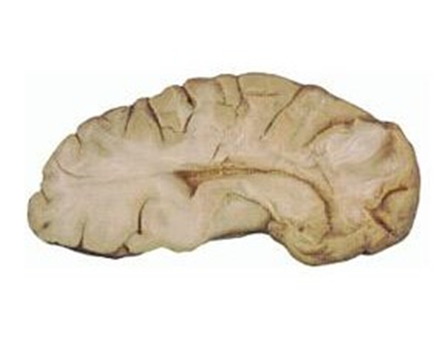 腦萎縮醫學標本