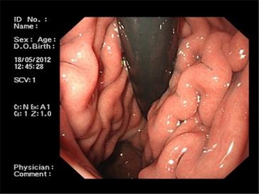 食道炎症狀 (34) 