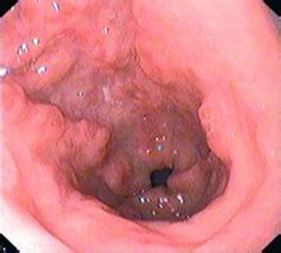 淺表型慢性胃炎