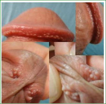 男性尖銳溼疣照片 (49) 