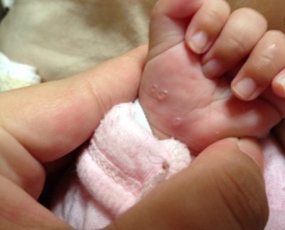 寶寶手上長水泡