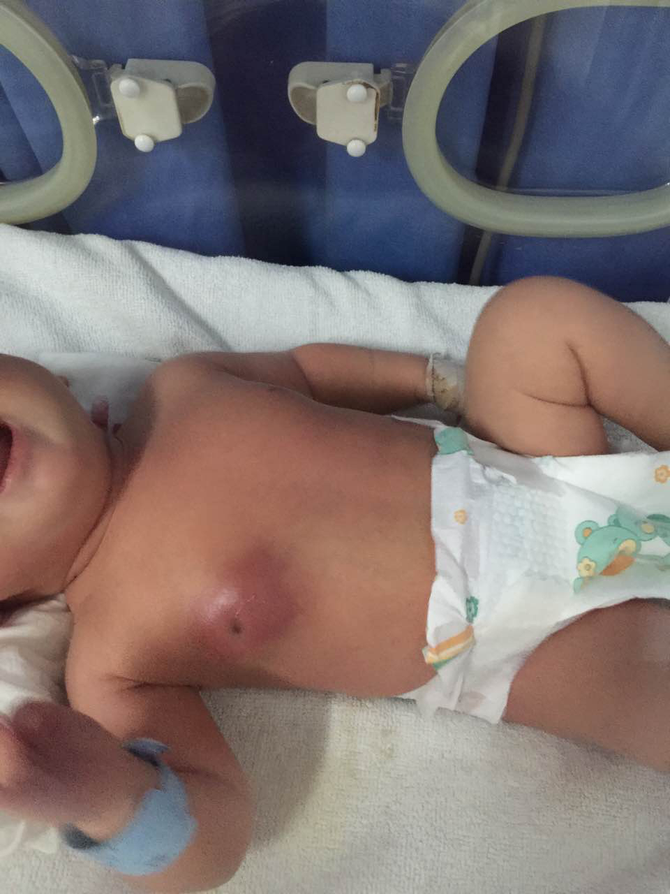 嬰兒乳房發育巨乳症