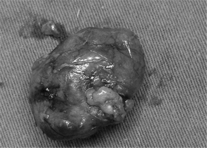 摘除的腎上腺腫瘤