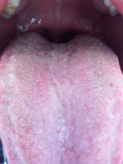 口腔念珠菌感染 (9) 