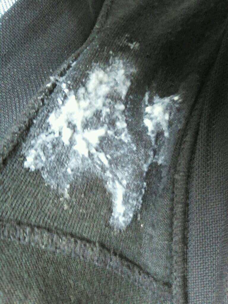 女性陰道白色念珠菌感染 