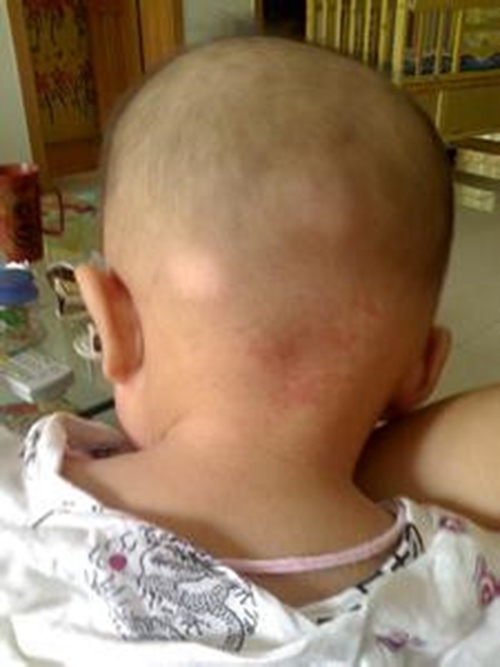 嬰兒的淋巴結髮炎