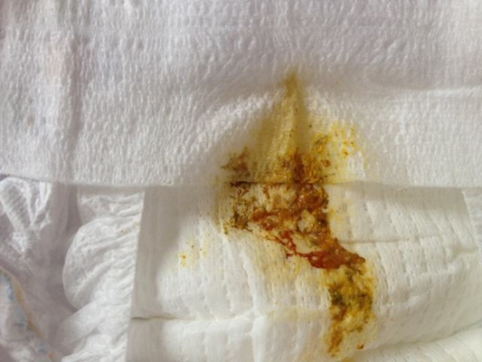 腸癌的症狀 (47) 