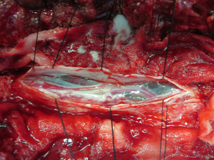 雙側額葉進展性出血腦疝