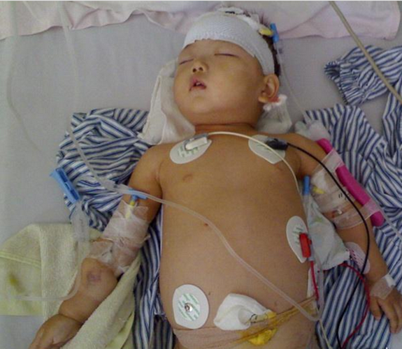 新生兒腦腹水症狀