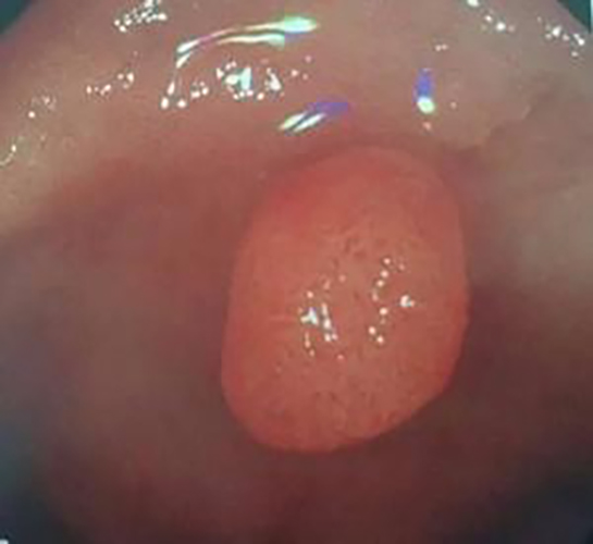 早期良性胃息肉