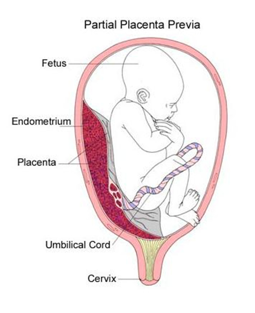 邊緣性胎盤早剝