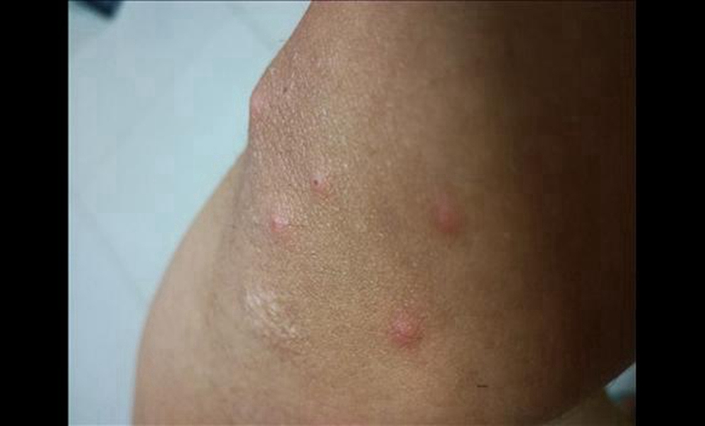 症狀流感檢查初期