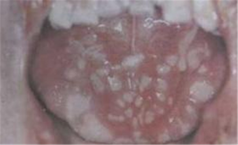 白塞病中期舌頭