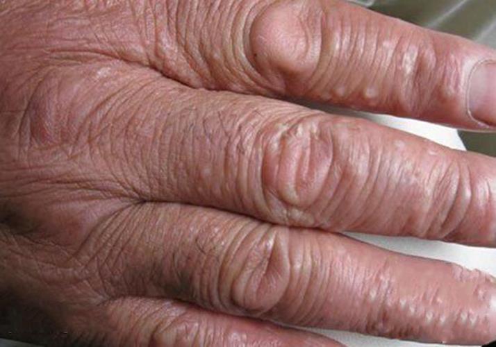 老大爺手部溼疹的