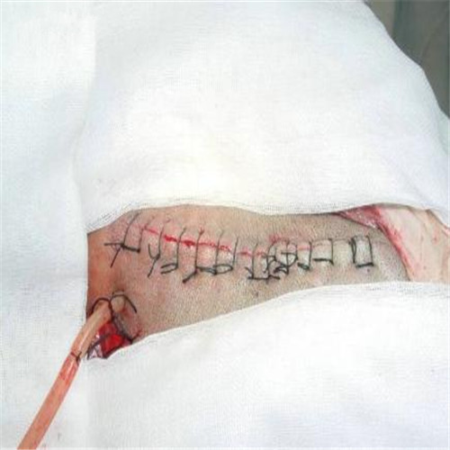 潰瘍性結腸炎術後傷口